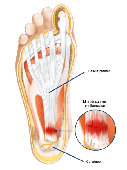 Fàscia plantar